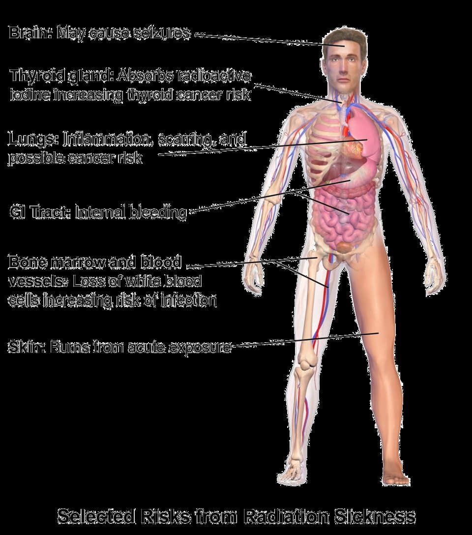 Radiation sickness symptoms timeline chart used for acute radiation syndrome triage